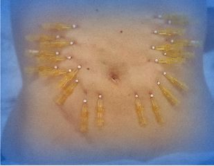 Clínica Granado Tiagonce - hilos abdomen