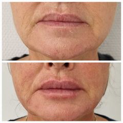 Aumento de labios - Clínica Granado Tiagonce