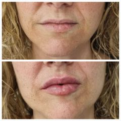 Aumento de labios - Clínica Granado Tiagonce