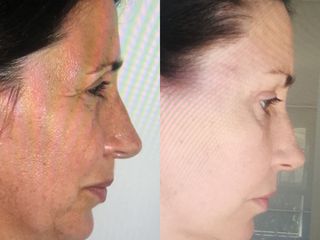 Rejuvenecimiento facial - Clínica Granado Tiagonce