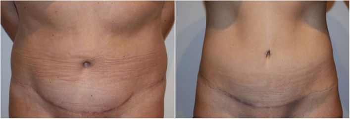 Abdominoplastia - Clínica Granado Tiagonce