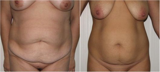 Abdominoplastia - Clínica Granado Tiagonce