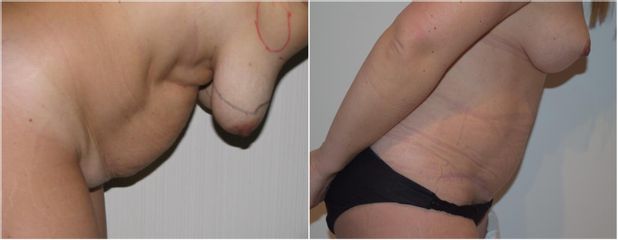 Abdominoplastia - Clínica Granado Tiagonce