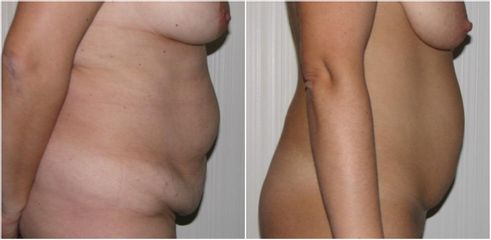 Abdominoplastia - Clínica Granado Tiagonce
