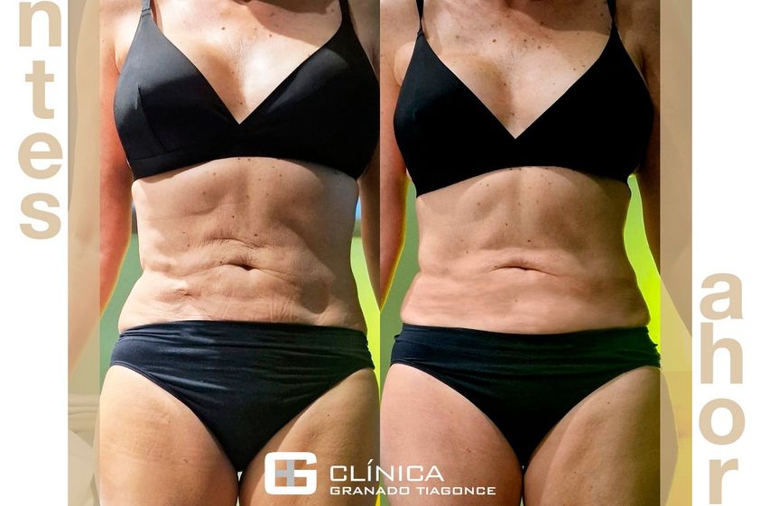 Celulitis antes y después - 854811