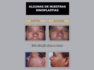 Rinoplastia - Clínica Granado Tiagonce