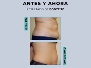 Bodytite - Clínica Granado Tiagonce