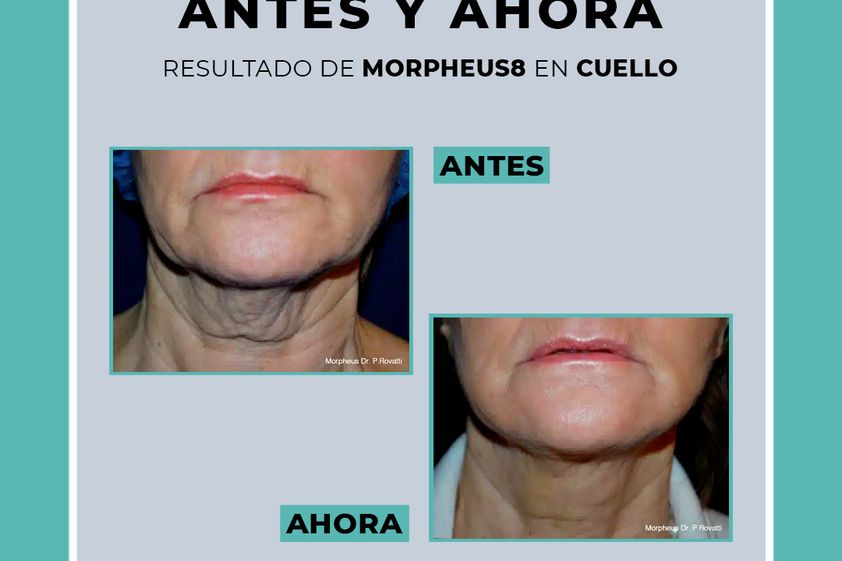 Radiofrecuencia facial antes y después - 854824