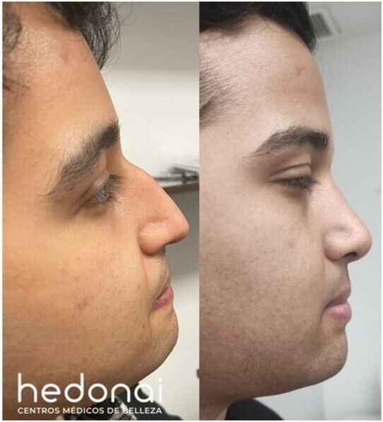 Hedonai laser fashion opiniones