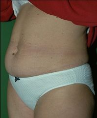 Abdominoplastia - Antes