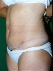 Abdominoplastia - Después