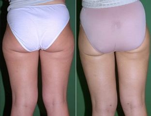 Liposucción