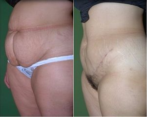 Abdominoplastia. Antes y después.