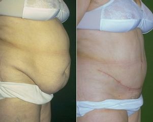 Abdominoplastia. Antes y después.