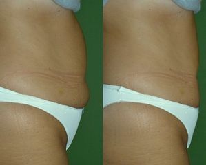 Liposucción abdominal