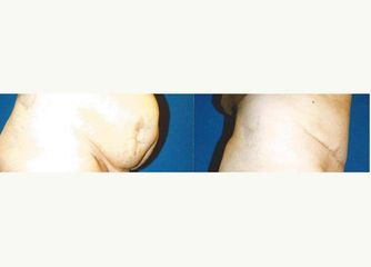 Abdominoplastia