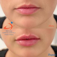 Aumento de labios - Clínica Decorps