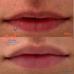Aumento de labios - Clínica Decorps