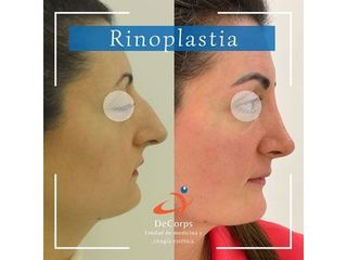 Rinoplastia - Clínica Decorps