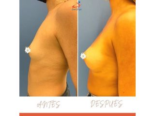 Aumento de pecho - Clínica Decorps