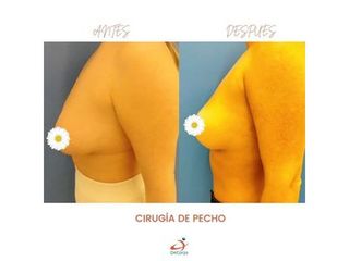 Aumento de pecho - Clínica Decorps