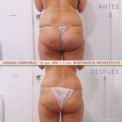 Cavitación - Integral Sthetic