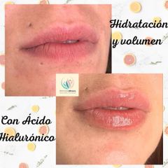 Aumento de labios - Centro Médico Primo De Rivera