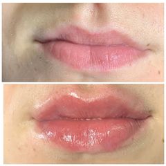 Aumento de labios - Centro Médico Primo De Rivera