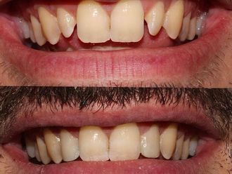 Carillas dentales - 815192