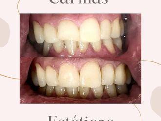 Carillas dentales - 815195