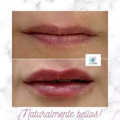 Aumento de labios - Centro Médico Primo De Rivera