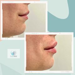 Aumento de labios - Centro Médico Primo De Rivera