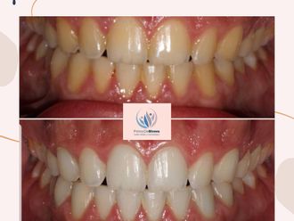 Blanqueamiento dental - 815864