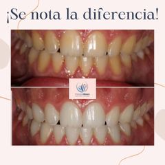 Blanqueamiento dental con lámpara LED - Centro Médico Primo De Rivera