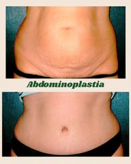 Abdominoplastia - Centro Médico Primo De Rivera
