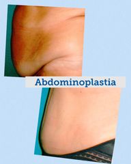 Abdominoplastia - Centro Médico Primo De Rivera
