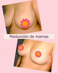 Reducción senos - Centro Médico Primo De Rivera