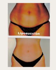 Liposucción - Centro Médico Primo De Rivera