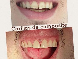 Carillas dentales - 821818