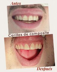 Carillas dentales - Centro Médico Primo De Rivera