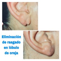 Cirugía reconstructiva de lóbulo de oreja - Centro Médico Primo De Rivera