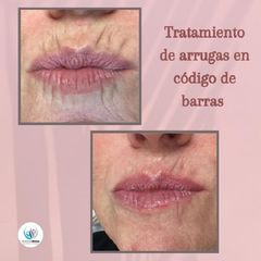 Rellenos faciales - Centro Médico Primo De Rivera