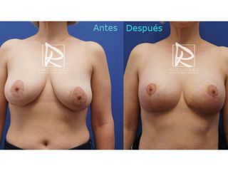 Antes y después Aumento de pecho