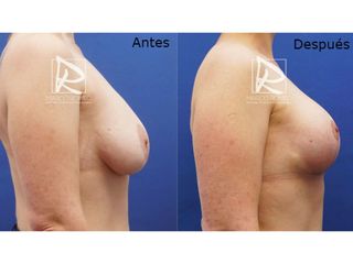 Antes y después Aumento de pecho