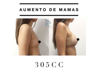 Antes y después Aumento de mamas