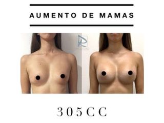Antes y después Aumento de mamas