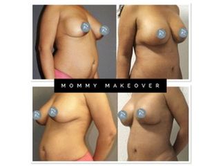 Antes y después Mommy Makeover