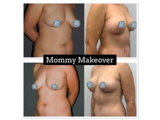 Antes y después Mommy Makeover