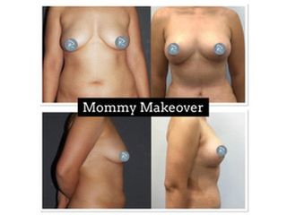 Antes y después Mommy Makeover