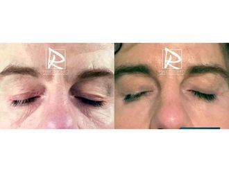 Blefaroplastia - 643168